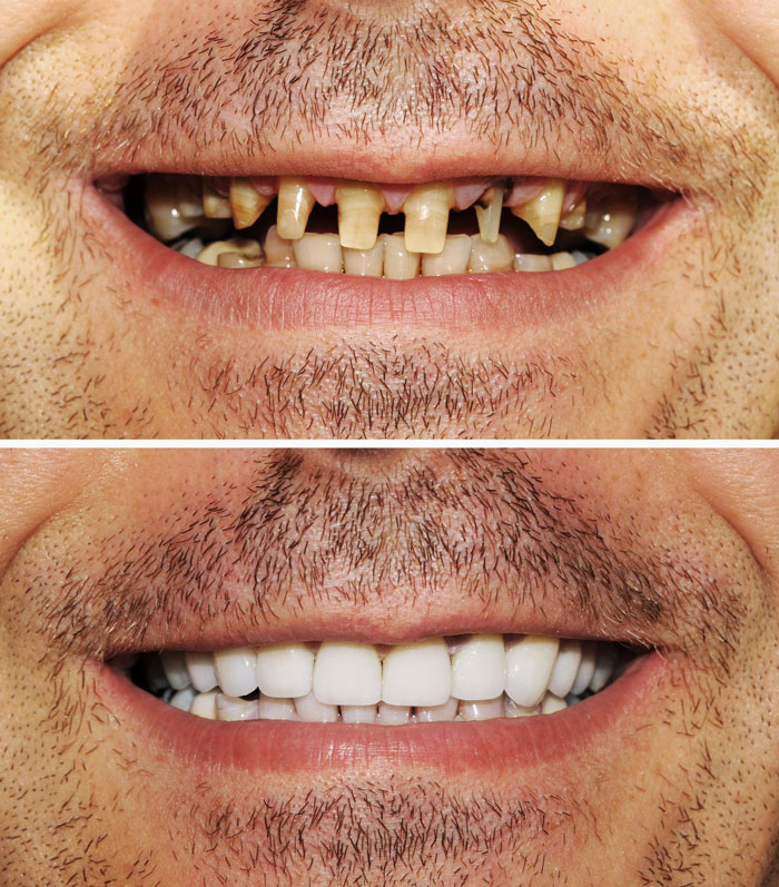 Marangaroo-Dental-Bridges-Highclere-Dental-Centre-image1