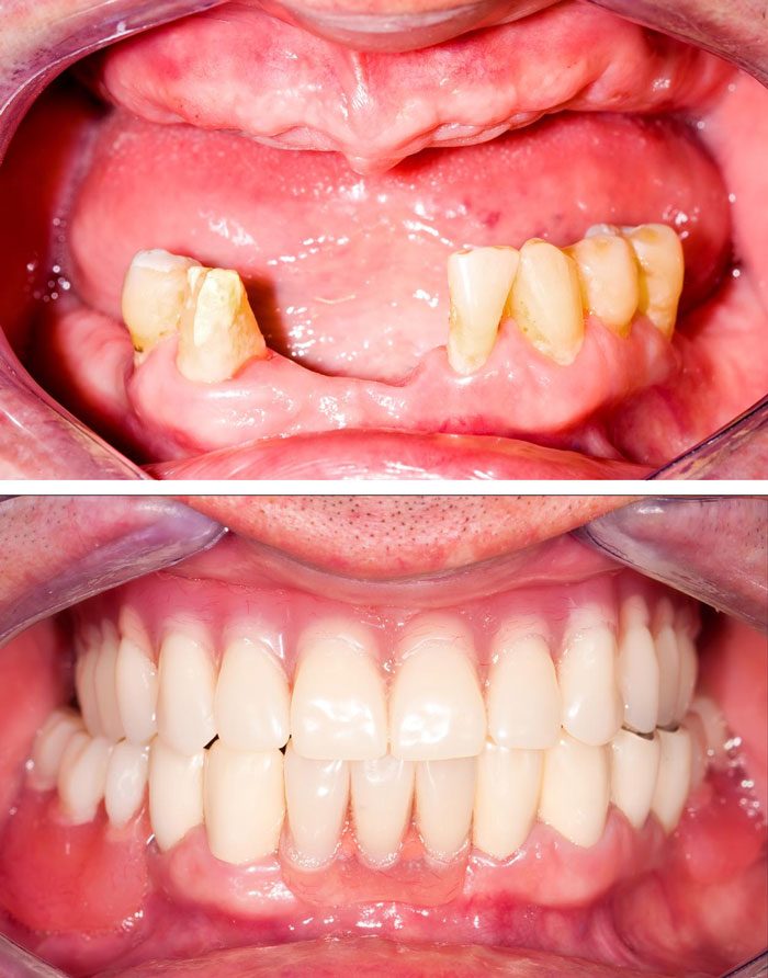 Marangaroo-Dentures-Highclere-Dental-Centre-treatment